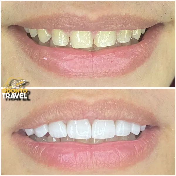 imagen Diseño de Sonrisa Ceromeros 